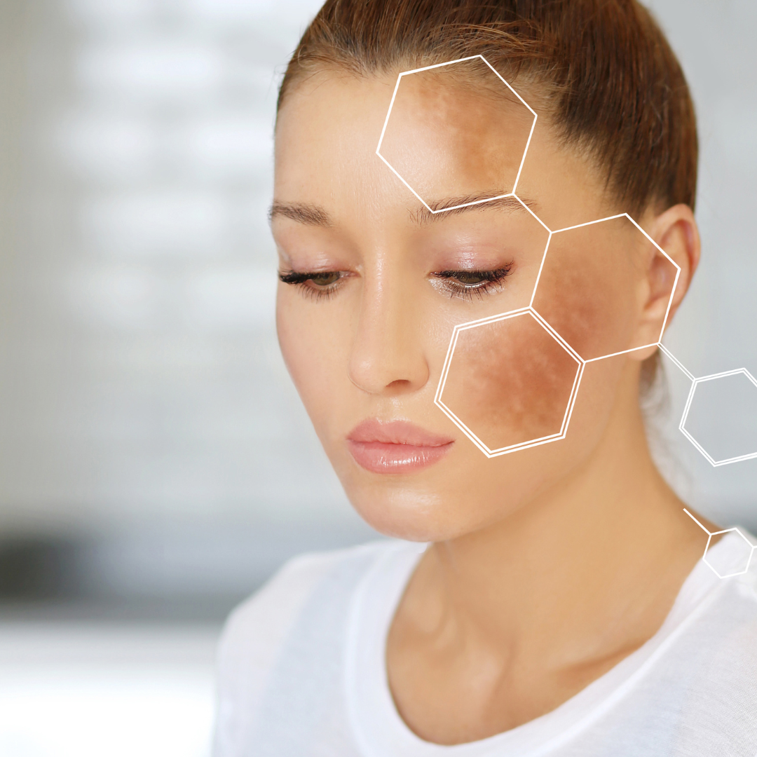 LAS MANCHAS EN LA CARA NO SIEMPRE SON MELASMA.