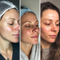 Limpieza Facial Profunda