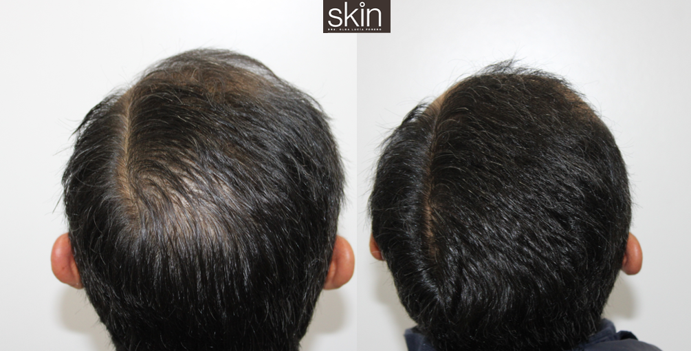 Mesoterapia Capilar