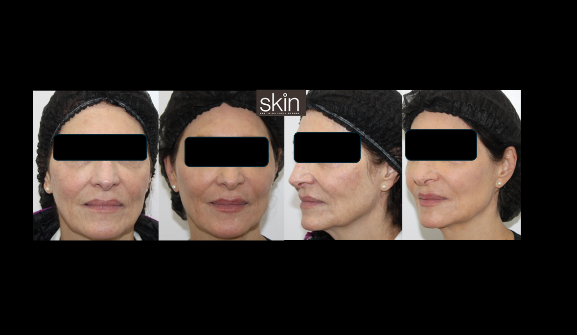 Armonización Facial