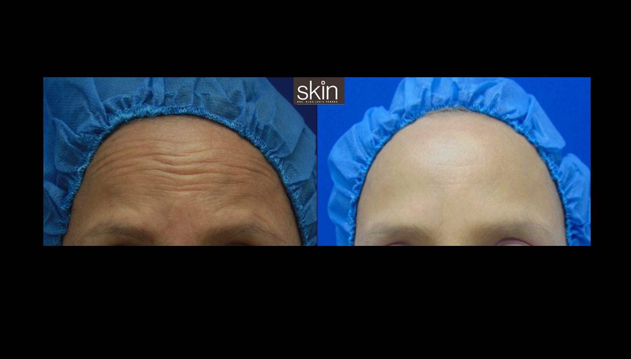 Toxina Botulínica Tipo A - ( Botox / Dysport )